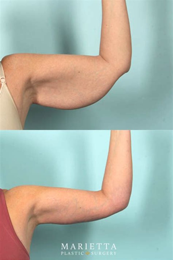 Bert Kreischer Arm Surgery Before And After: Health Update 2023