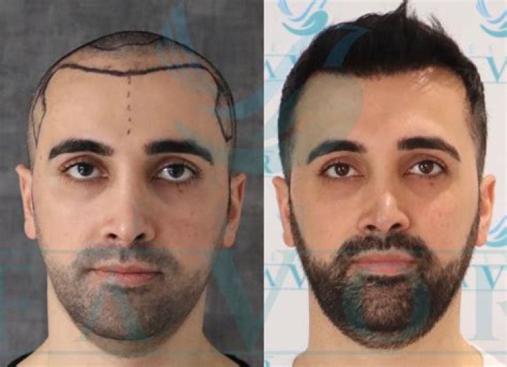Best Top 11 Hair Transplant Clinics In Turkey – 2024
