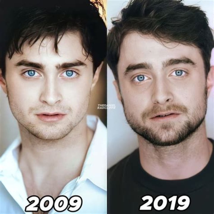 Daniel Radcliffe Nose Job: Before And After Photos