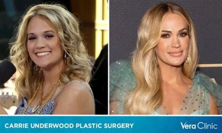 Did Carrie Underwood Get Plastic Surgery or Was She Really in an Accident?