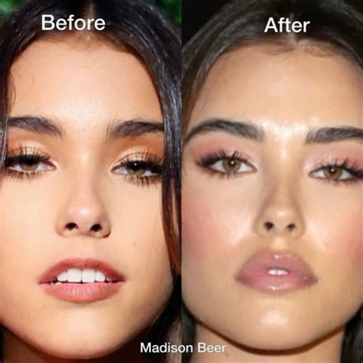 Madison Beer before and after Getting Silicone Lip Fillers — What Went Wrong?