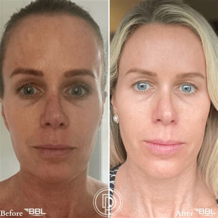 Marlene Oi Mae Grande Before Surgery: Before And After BBL